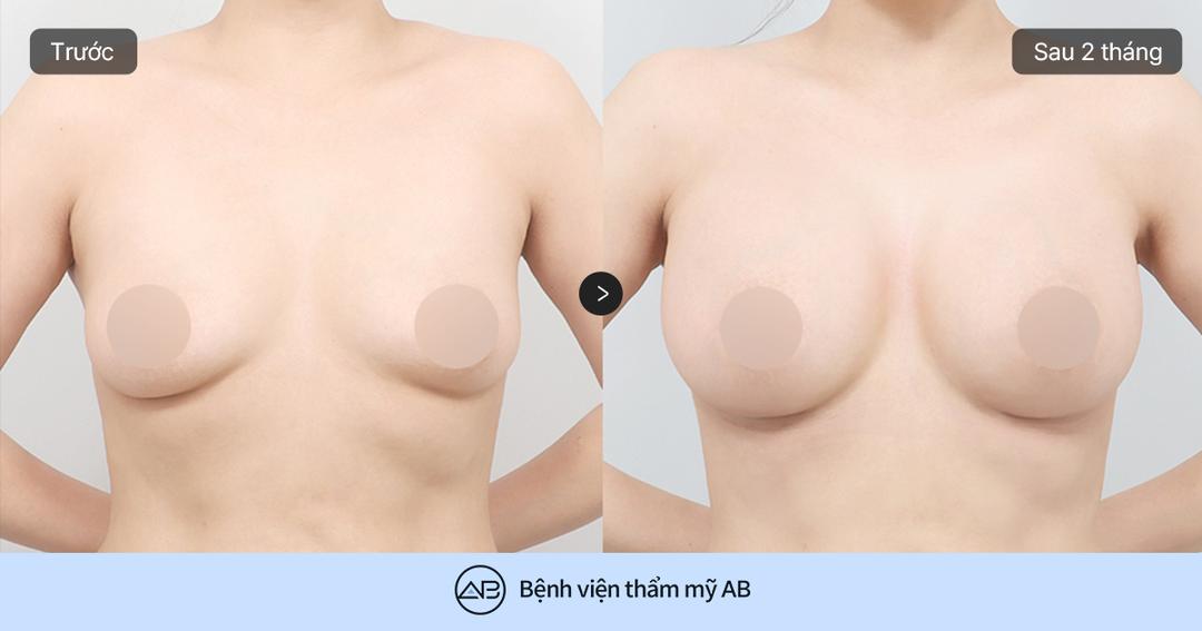 Phẫu thuật ngực chảy xệ: Nguyên nhân, mức độ và phương pháp nâng ngực