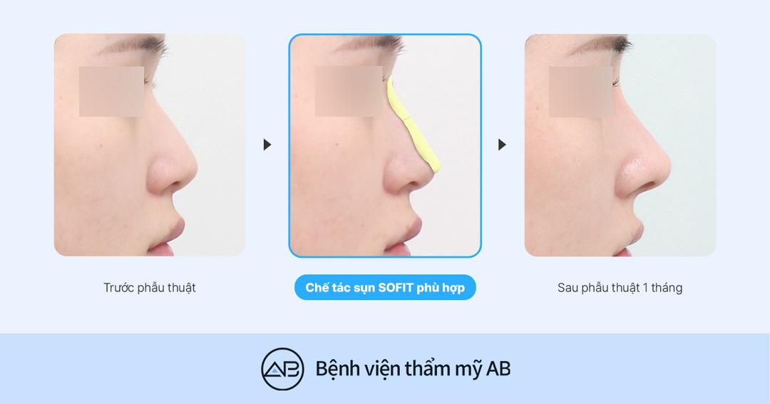 Nâng mũi SOFIT khác gì so với nâng mũi sụn silicon thông thường? Khi nào nên dùng sụn thiết kế riêng?