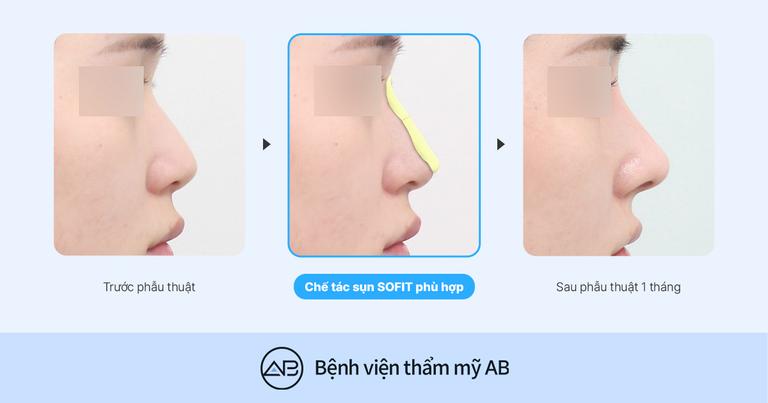 Phẫu thuật thẩm mỹ AB