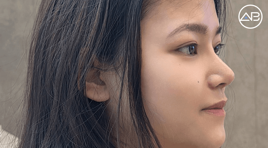 Nâng mũi thôi mà thay đổi cả diện mạo! Biết vậy mình làm sớm hơn rồi!