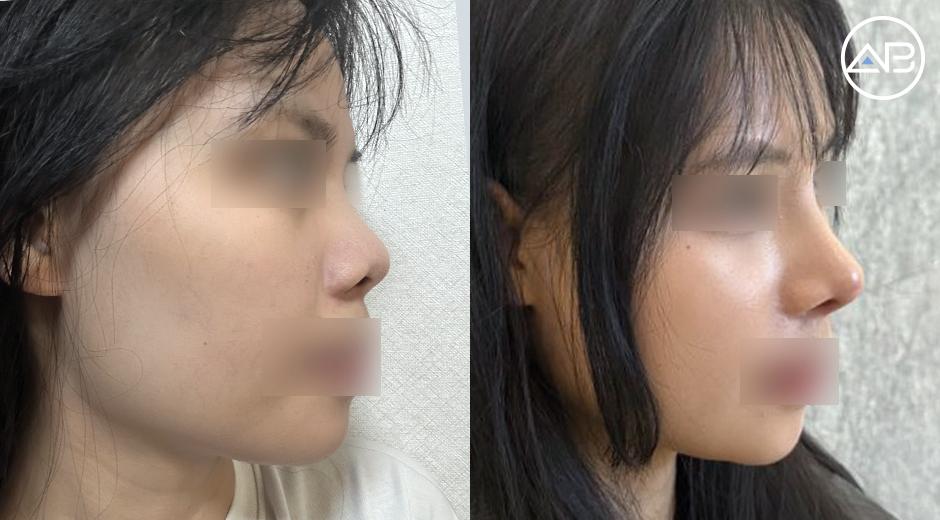 Thay đổi cả gương mặt sau 3 tháng nâng mũi tại AB