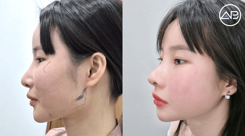Review 3 tháng sau tái nâng mũi, hạ gò má và gọt hàm tại bệnh viện thẩm mỹ AB