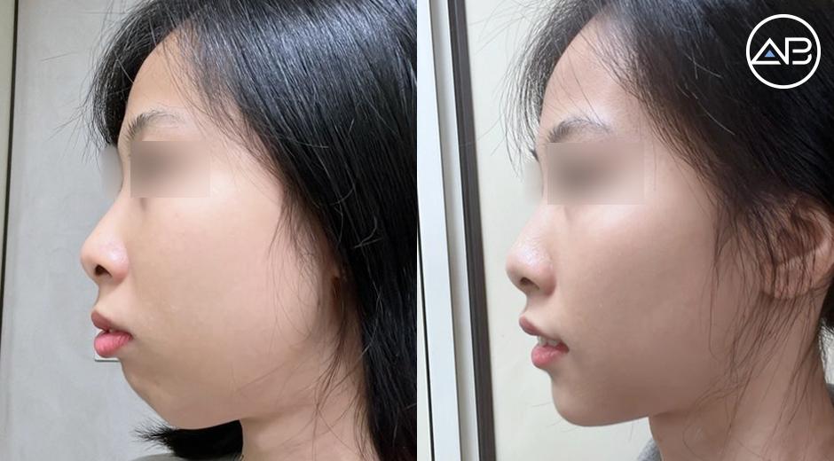 Gương mặt mình như được "lột xác" sau khi phẫu thuật trượt cằm lẹm! Biết vậy mình đã làm phẫu thuật sớm hơn rồi.