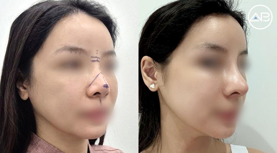 Review tái nâng mũi sụn sườn và tái cắt mí tại bệnh viện thẩm mỹ AB : Hành trình lấy lại sự tự tin sau phẫu thuật hỏng ở Việt Nam