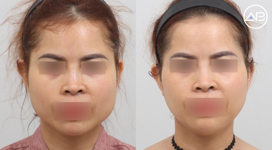 Review Gọt Hàm Vuông Hàn Quốc Tại AB – Sau 3 Tháng Sở Hữu Gương Mặt V-Line Thon Gọn Như Mong Ước