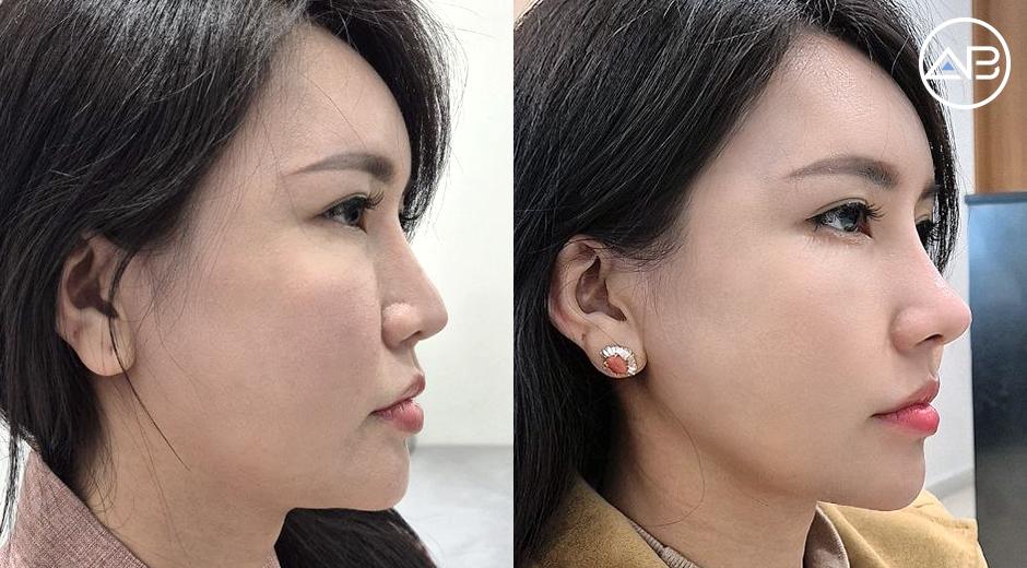 Sửa mũi lần 2 sau 5 năm: Từ dáng mũi dài, thô đến chiếc mũi thanh thoát tại AB