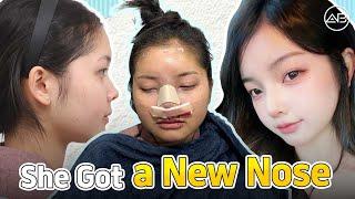 [phẫu thuật thẩm mỹ Hàn Quốc] 7 Ngày Sau Khi Nâng Mũi Tại Hàn Quốc [Part 2]