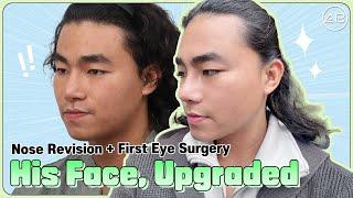 [phẫu thuật thẩm mỹ Hàn Quốc] Hot TikToker Việt Nam Lột Xác Sau Khi Nâng Mũi Và Mắt Tại Hàn Quốc [Part 1]