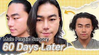 [phẫu thuật thẩm mỹ Hàn Quốc] Nam TikToker Việt Nam Sau Phẫu Thuật Thẩm Mỹ – Hành Trình Hồi Phục [Part 2]