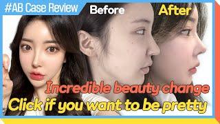    0:02 / 1:24   [Plastic Surgery in Korea] Click! if you want to be pretty✨│review of plastic surgery