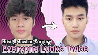 [phẫu thuật thẩm mỹ Hàn Quốc] Kết quả nâng mũi sau 7 ngày tại Hàn Quốc [Part 2]