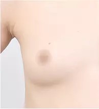 Trước phẫu thuật