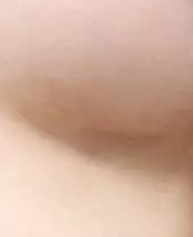 Đường cắt ở chân ngực sau 2 tháng