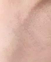 Vùng nách sau 2 tháng