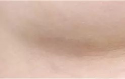 Sau phẫu thuật 3 tháng