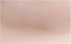 Sau phẫu thuật 10 tháng