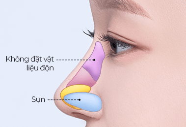 Prominent hump nose surgery — step 2