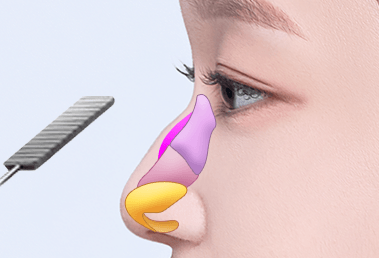 Phẫu thuật mũi gồ thấp — step 1