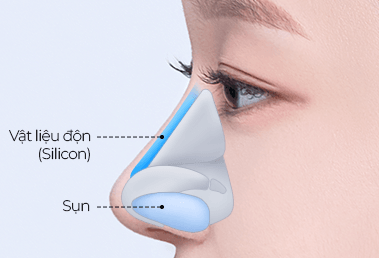 Phẫu thuật mũi gồ thấp — step 2