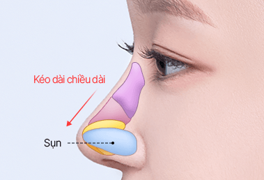 Short nose surgery — after: cartilage insertion and length extension
