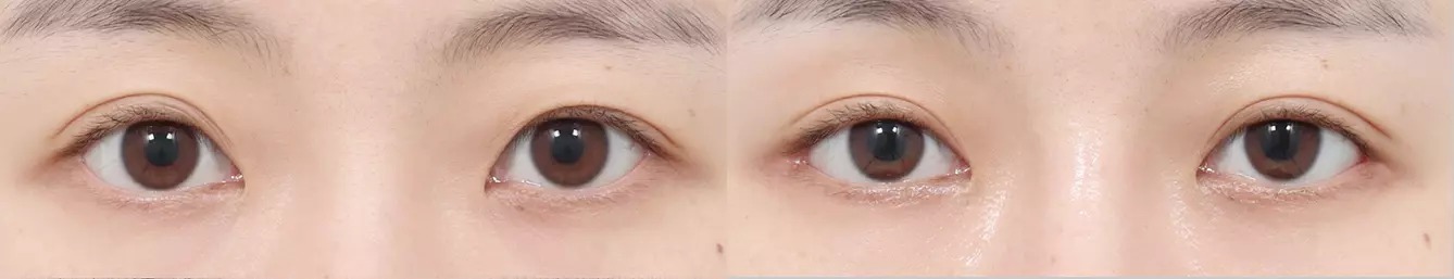 ABC point before and after case 4