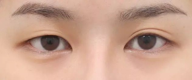 Trước nhấn mí tự nhiên và lộng lẫy