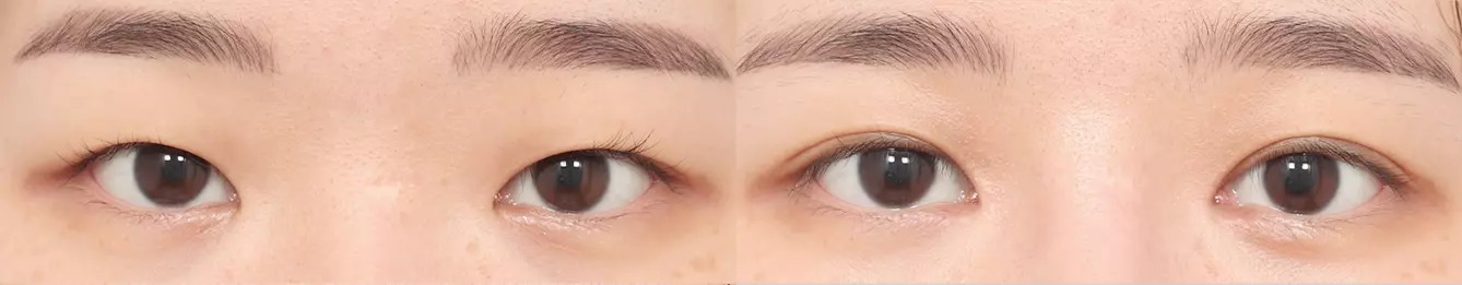 Eye line before and after case 1