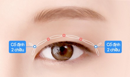 Minh họa phẫu thuật nhấn mí tự nhiên và lộng lẫy