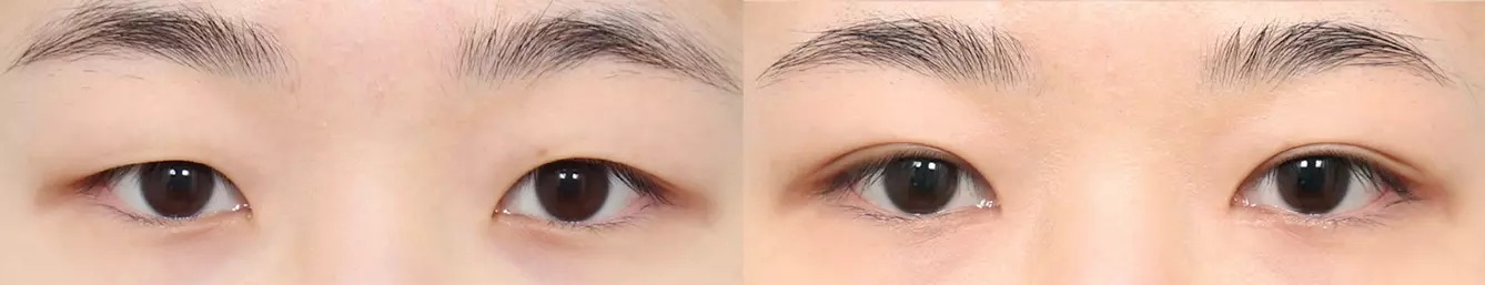 Trước và sau phẫu thuật mắt hai mí 1