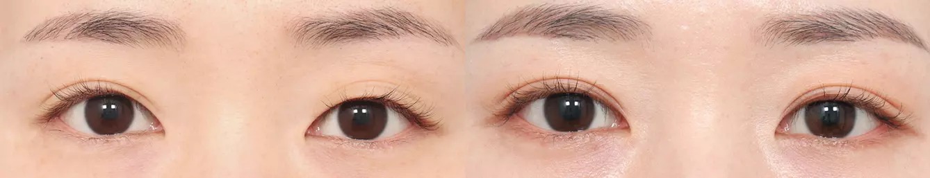 Trước và sau phẫu thuật mắt hai mí 2