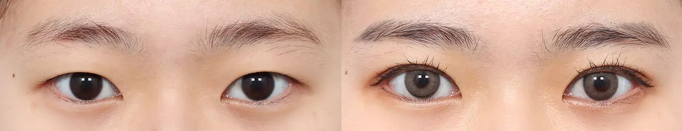 Trước và sau phẫu thuật mắt hai mí 3