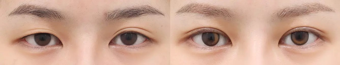 Trước và sau phẫu thuật mắt hai mí 4