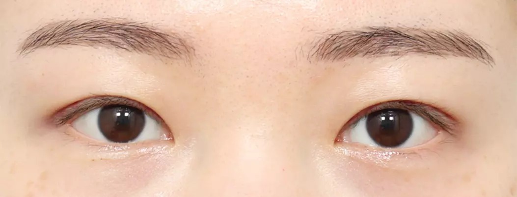 Sau 2 ngày nhấn mí tự nhiên