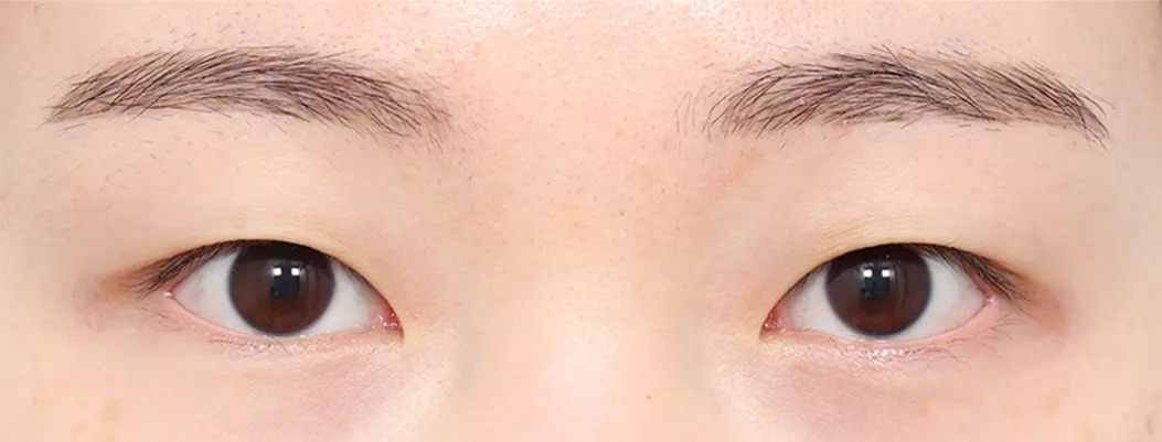 Trước nhấn mí tự nhiên