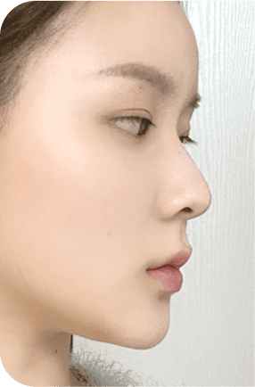nose after