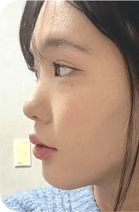 nose after