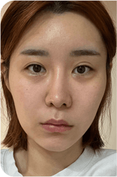 facial after