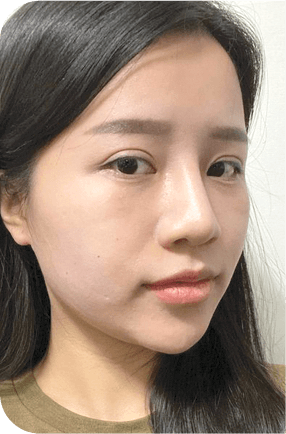 nose after