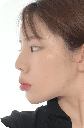 nose after