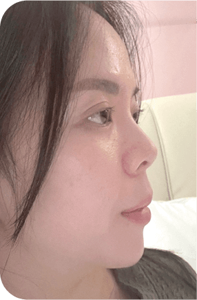 nose after