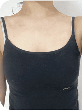 breast after