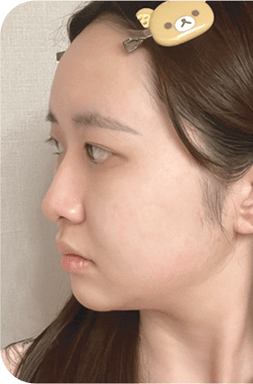 nose after