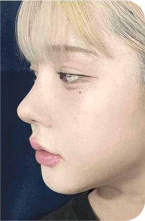 nose before