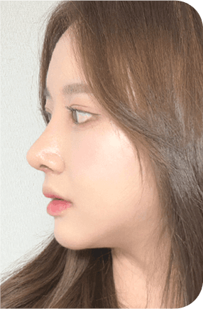 nose before