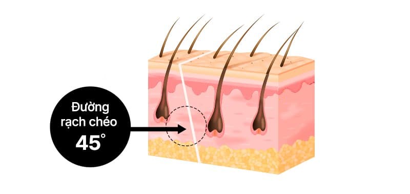 45-degree diagonal incision
