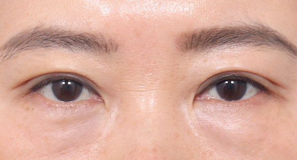 Nhờ cố định đường mí chắc chắn nên sau 1 tháng
không bị bung mí và đường mí duy trì tự nhiên