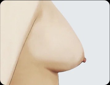 Ngực sa trễ độ 1