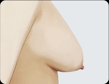 Ngực sa trễ độ 2