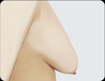 Ngực sa trễ độ 3