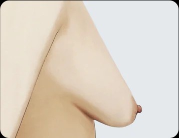 Ngực sa trễ giả